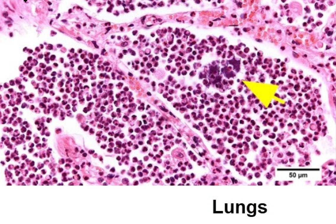 „Globale Zeitbombe“ Erster Fall einer Obduktionsstudie an einem gegen SARS-CoV-2 geimpften Patienten;  "virale RNA findet sich in jedem Organ des Körpers"