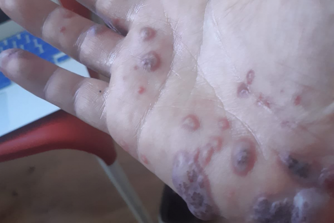 Triple or Quadruple COVID-Vax Recipients Now Developing SORES -- **NOT** Monkeypox